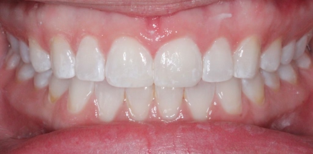 Repairing a chipped front tooth — after