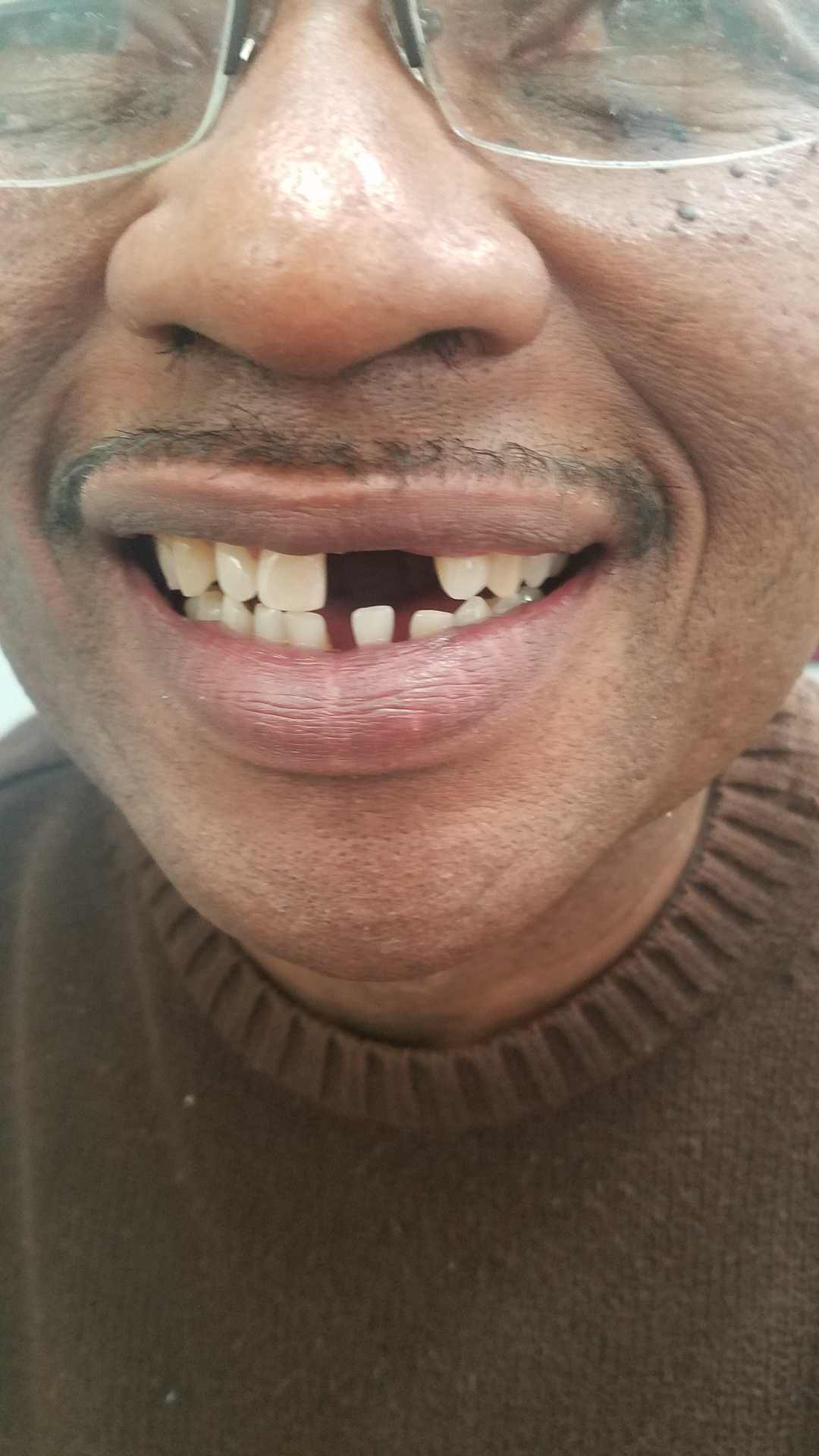Replacing missing front teeth — before