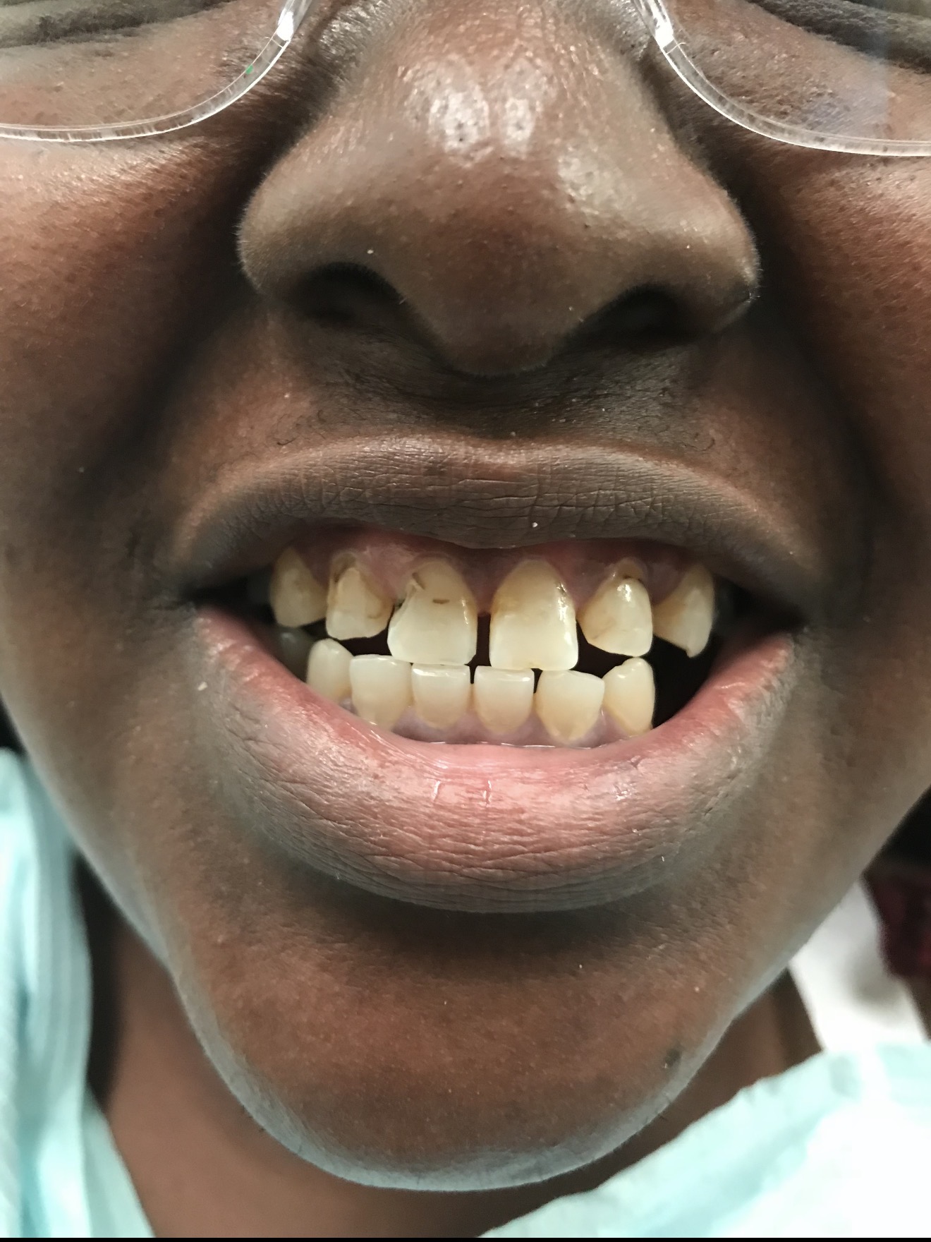 A more balanced smile — before