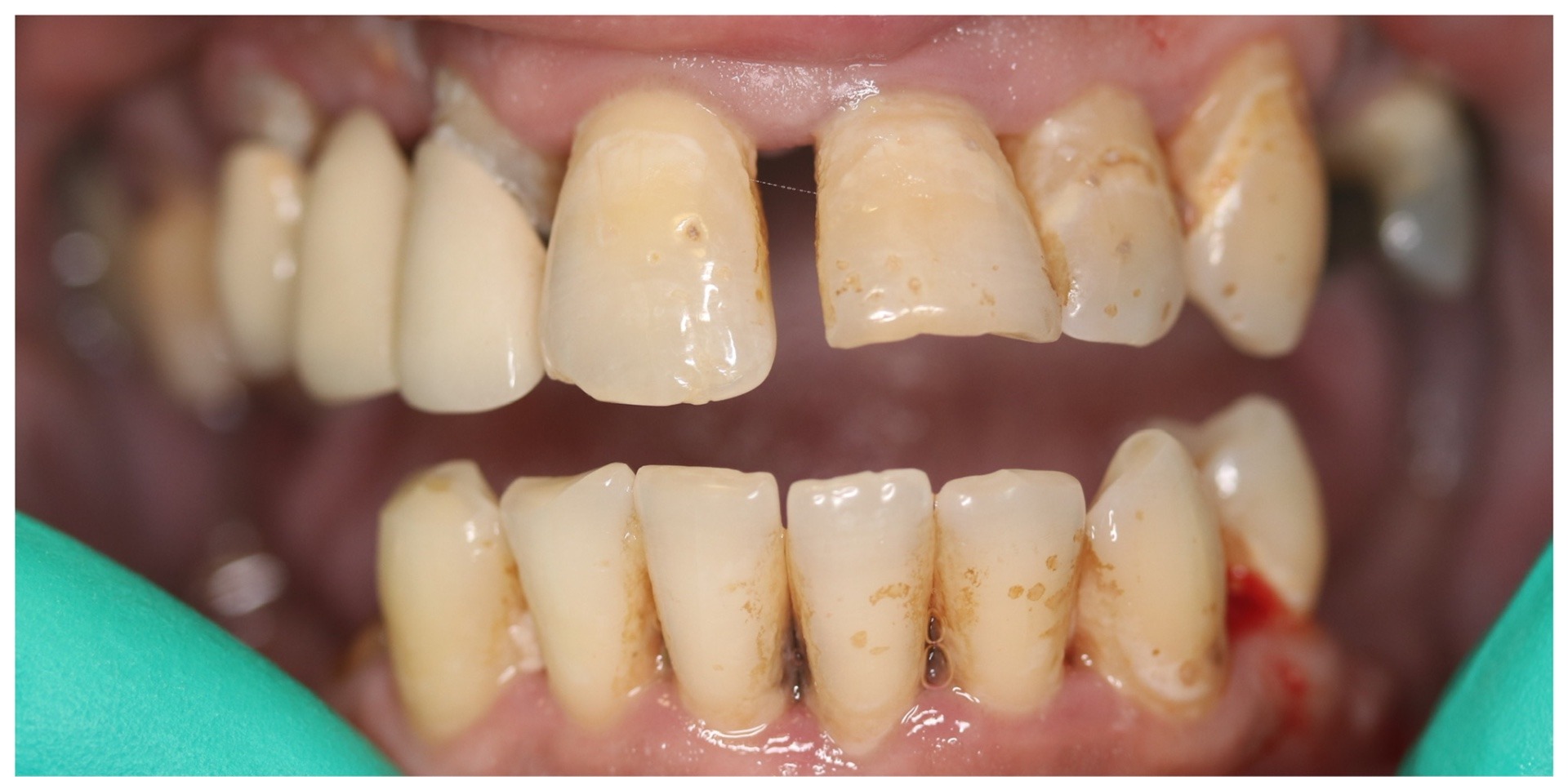 Restoring worn and damaged teeth — before