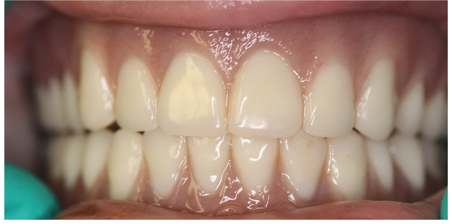Restoring worn and damaged teeth — after