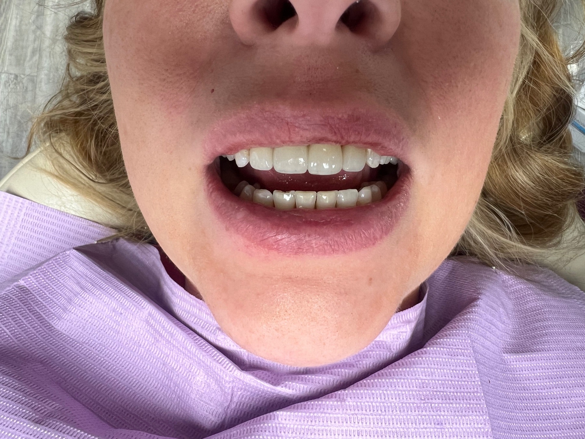 Rebuilding front teeth — after