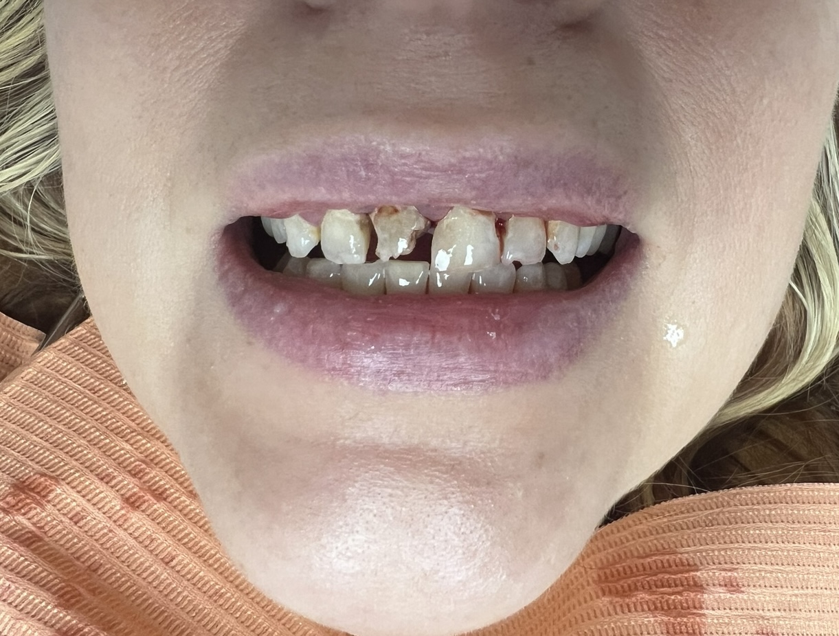 Rebuilding front teeth — before