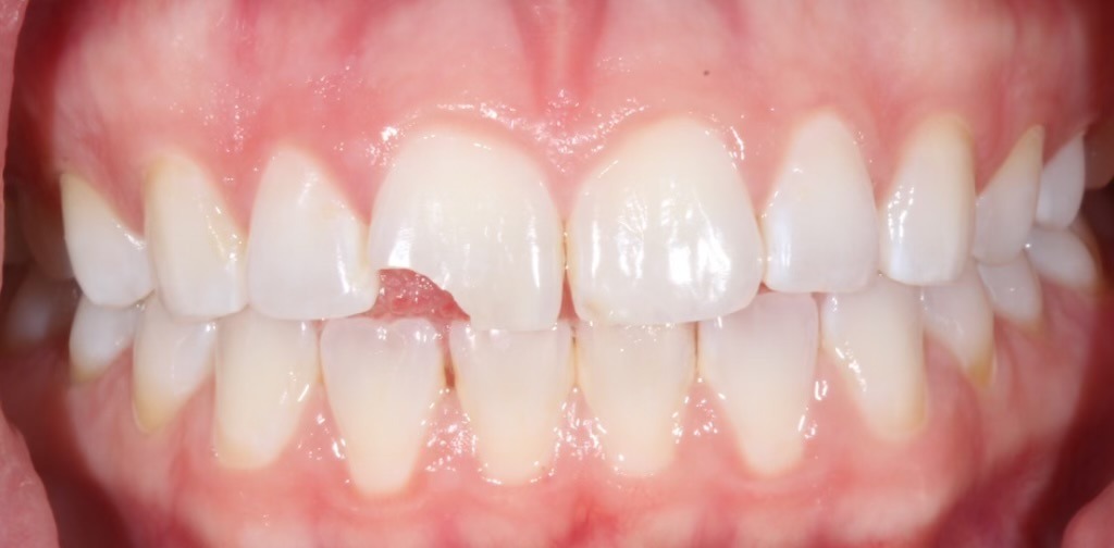 Repairing a chipped front tooth — before