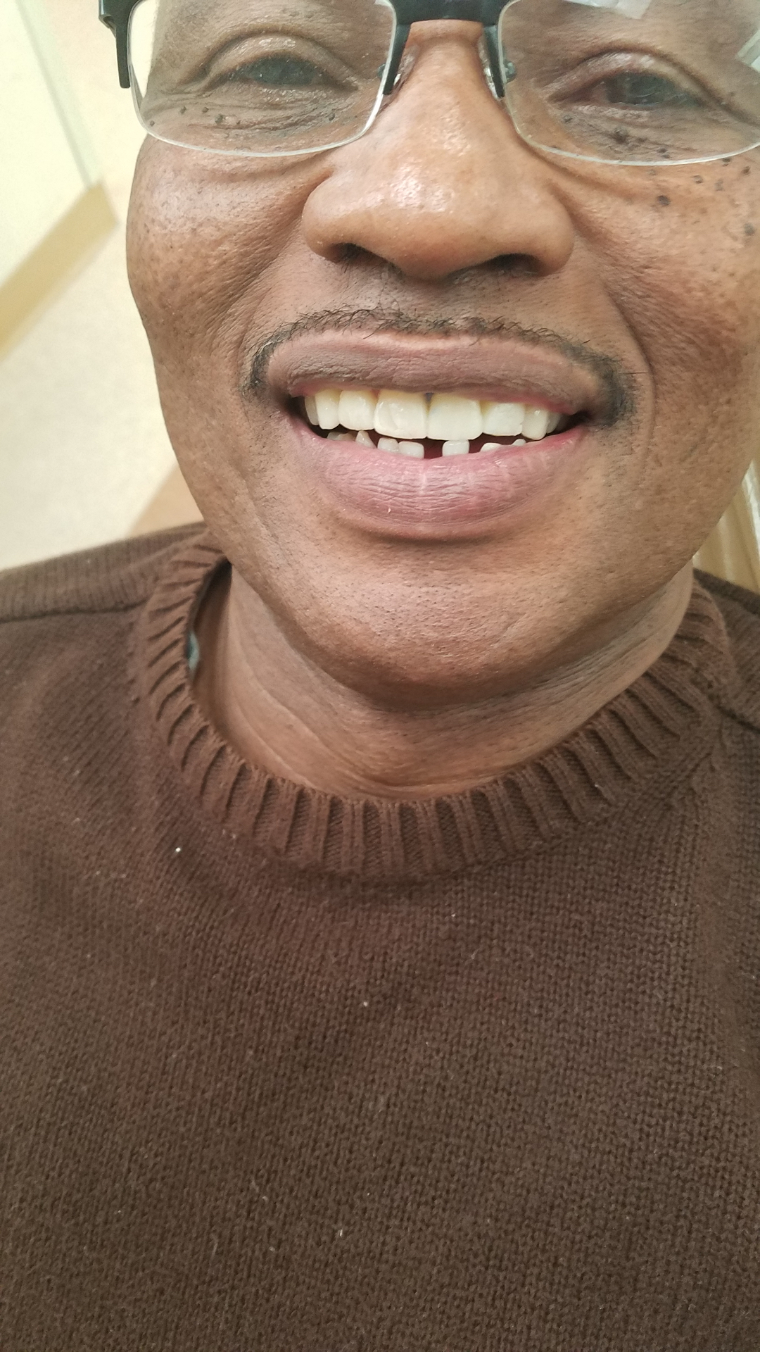 Replacing missing front teeth — after