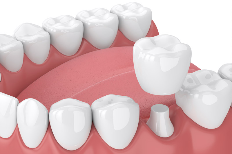 Dental Crowns in Tallapoosa