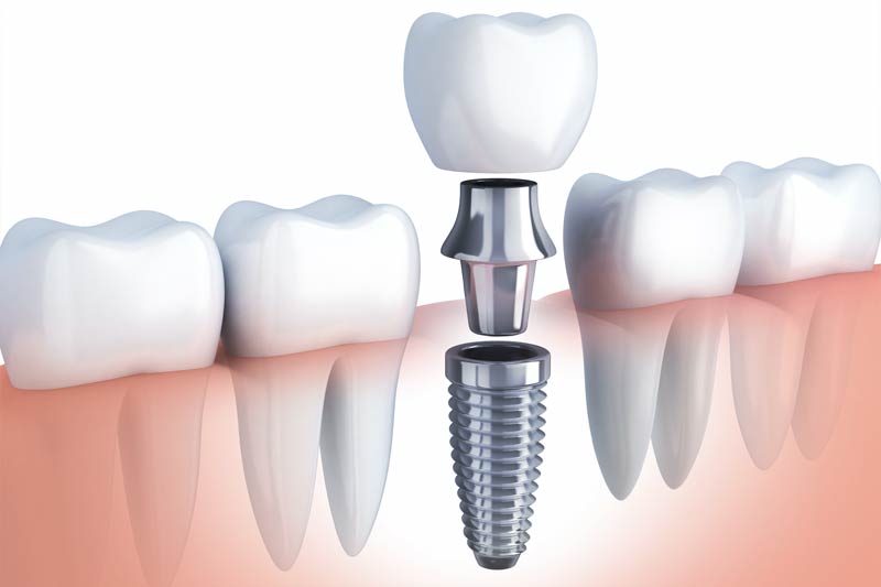 Implants Dentist in Haralson County