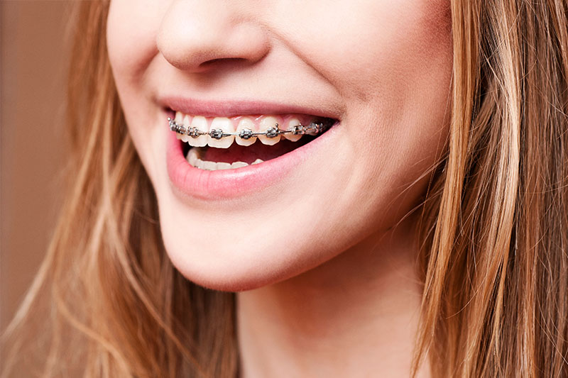 Orthodontics in Haralson County