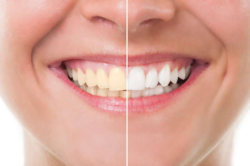 Teeth Whitening in Haralson County