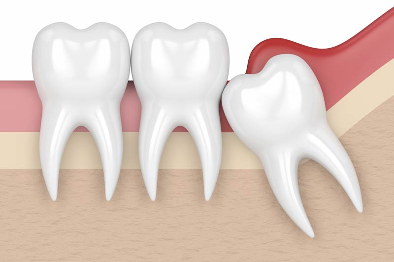 Wisdom Tooth Removal in Haralson County